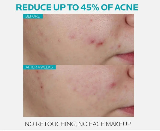 La Roche-Posay Effaclar Salicylic Acid Acne Treatment Serum – 30ml (1.0 fl. oz.) Daily Clarifying Exfoliator NORTH WAVE SCENTORA