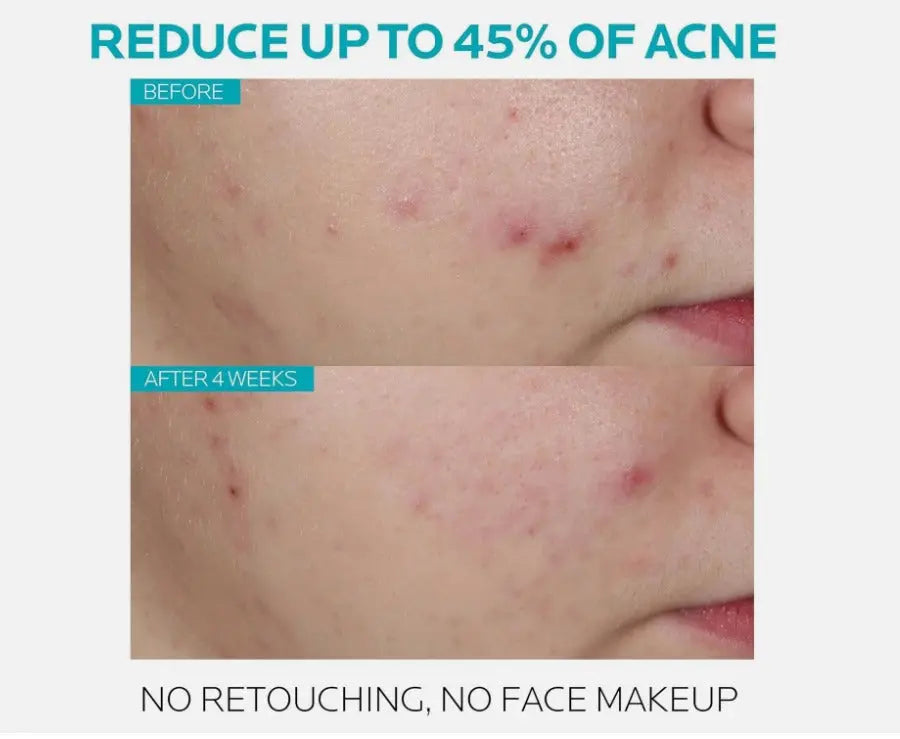 La Roche-Posay Effaclar Salicylic Acid Acne Treatment Serum – 30ml (1.0 fl. oz.) Daily Clarifying Exfoliator NORTH WAVE   SCENTORA
