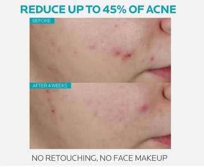 La Roche-Posay Effaclar Salicylic Acid Acne Treatment Serum – 30ml (1.0 fl. oz.) Daily Clarifying Exfoliator NORTH WAVE   SCENTORA